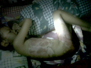 Rara 3 bulan menderita luka bakar Parah
